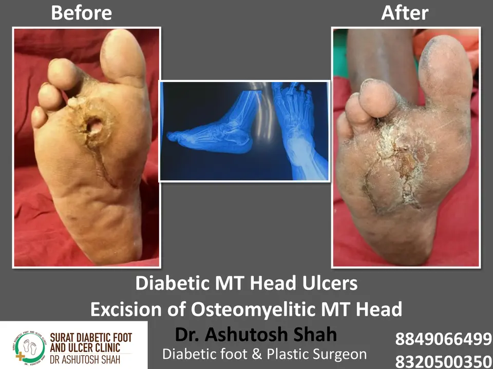 Diabetic Foot  PPT sunita.pptx-29.webp